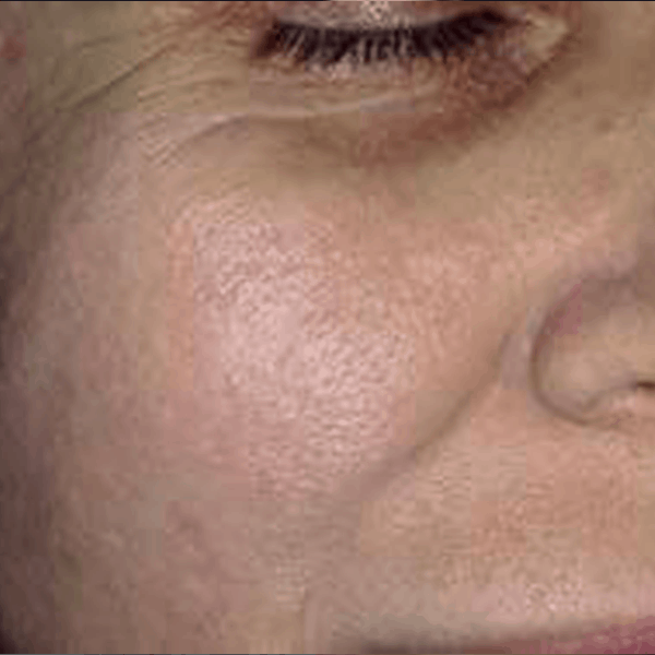 Post-acne-scars-ETCA-after