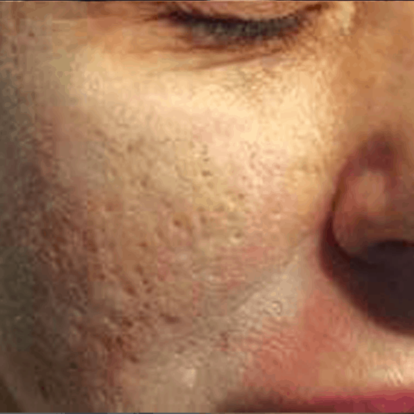 Post-acne-scars-ETCA-before